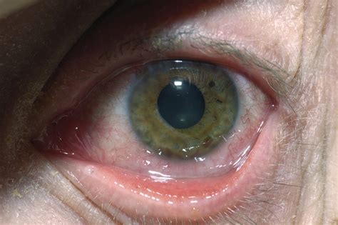 hsv eye infection